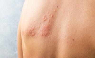 έρπητας ζωστήρας